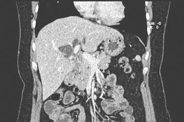 图4 增强CT（2018年1月）